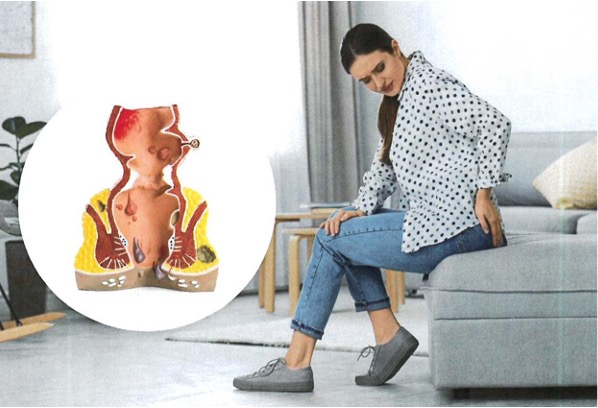 An anatomical model of the rectum with hemorrhoids, and a young woman sitting on the sofa, suffering from pain at home.